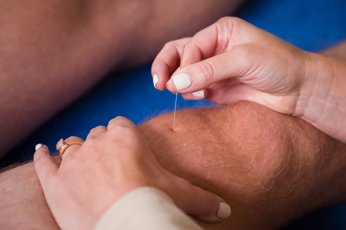 Dry needling